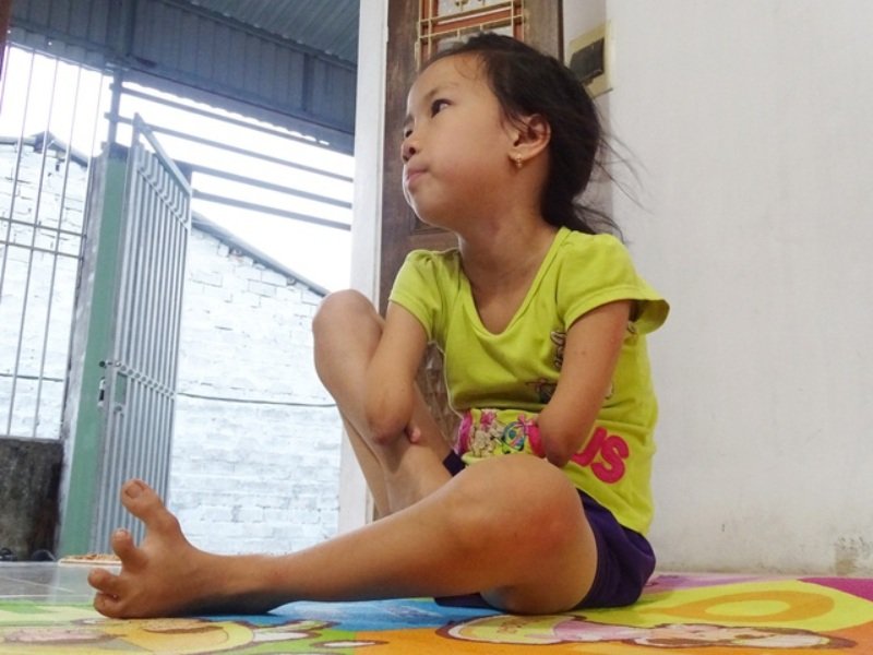 Mơ thấy bị cụt tay quả là ác mộng và không ai mong muốn nó sẽ xảy ra
